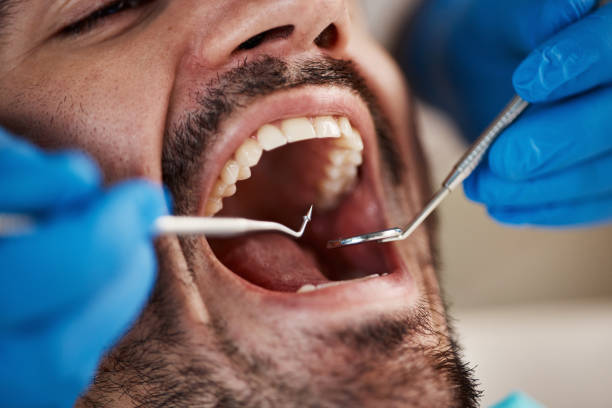 Best Emergency Wisdom Teeth Removal in Mcalester, OK